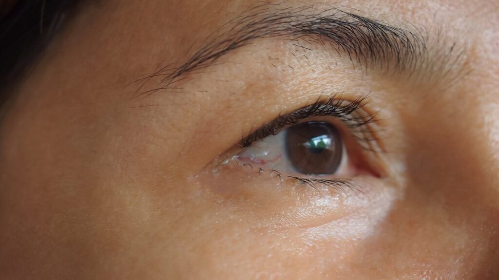 Patient's eye After treatment