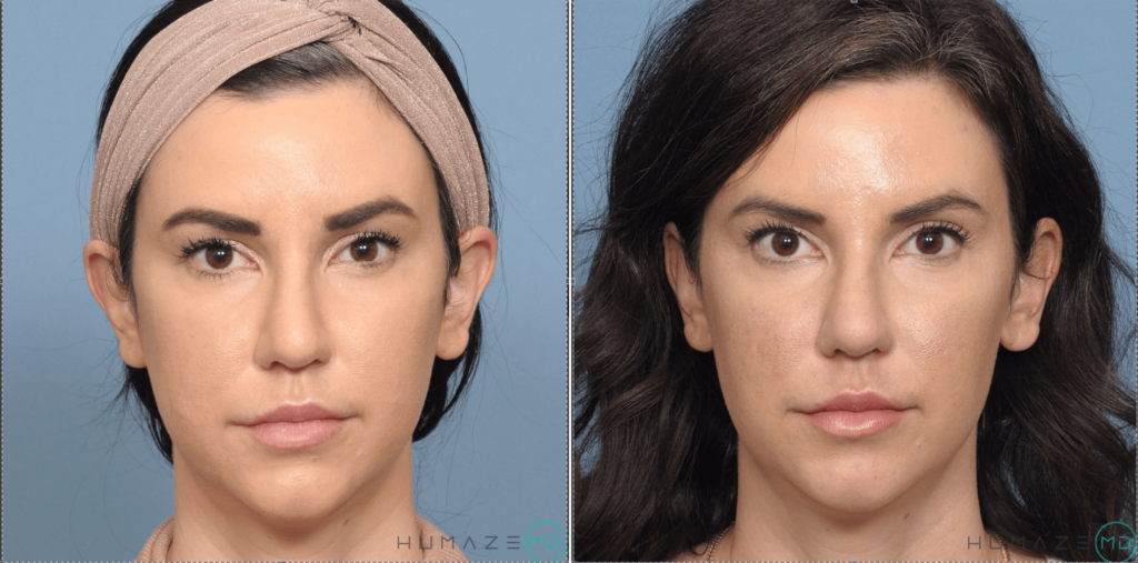 Buccal Fat Reduction