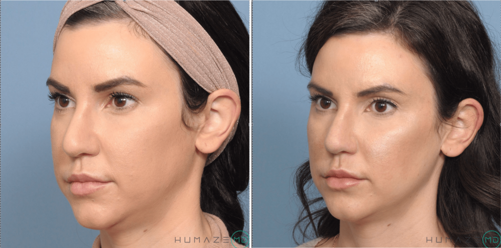 Buccal Fat Reduction