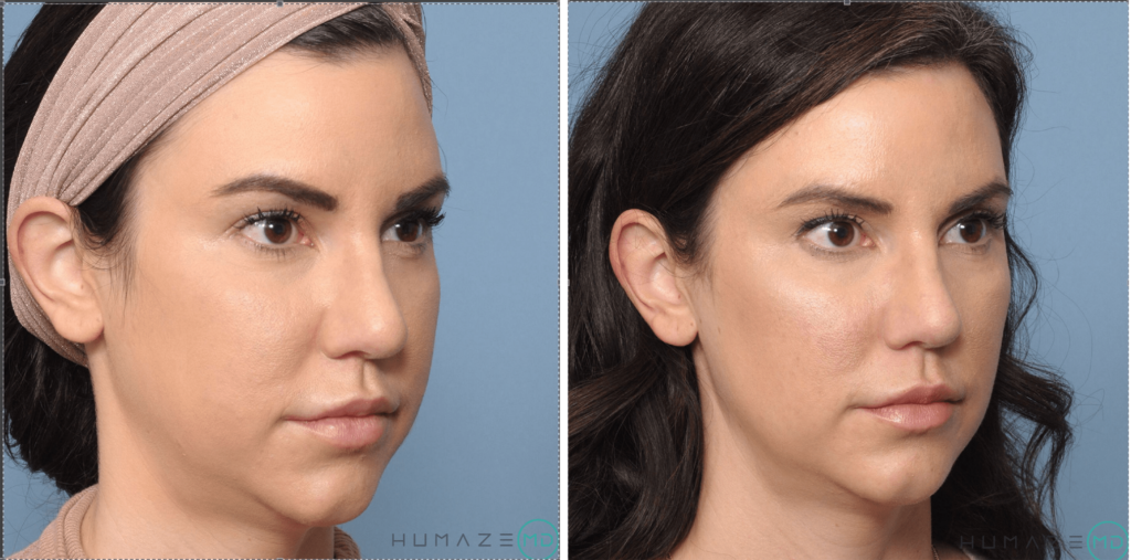 Buccal Fat Reduction