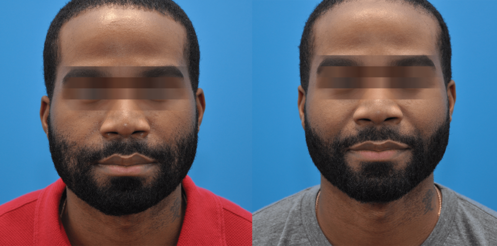 Buccal Fat Reduction