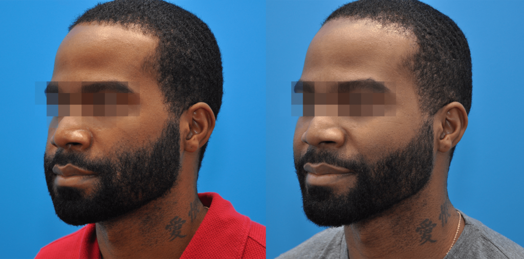 Buccal Fat Reduction