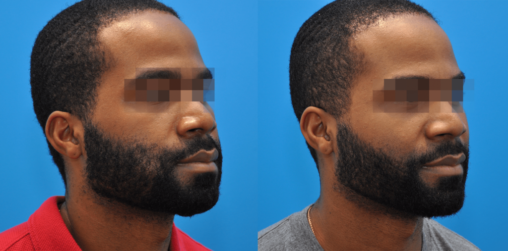 Buccal Fat Reduction