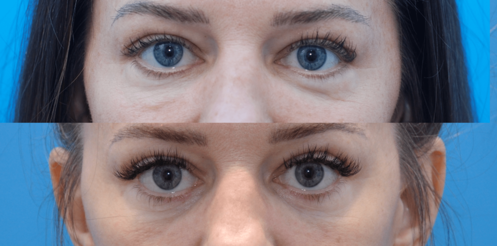 Facelift, necklift, upper bleph, lower blepharoplasty with fat grafting, chemical peel