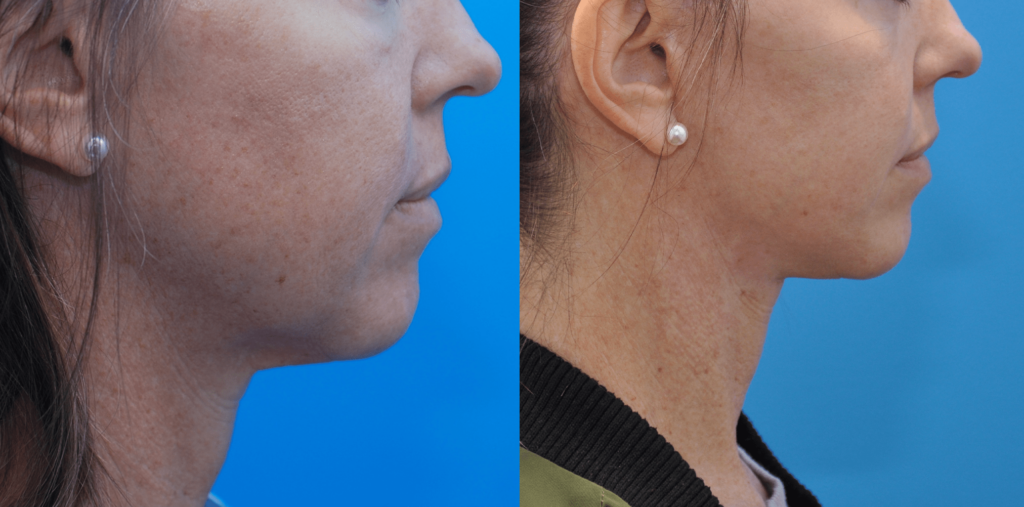 Facelift, necklift, upper bleph, lower blepharoplasty with fat grafting, chemical peel