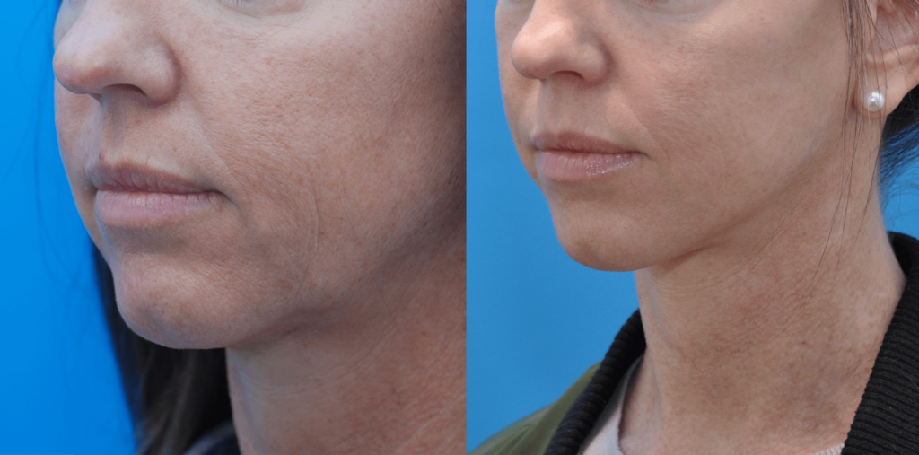 Facelift, necklift, upper bleph, lower blepharoplasty with fat grafting, chemical peel