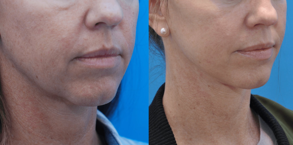 Facelift, necklift, upper bleph, lower blepharoplasty with fat grafting, chemical peel