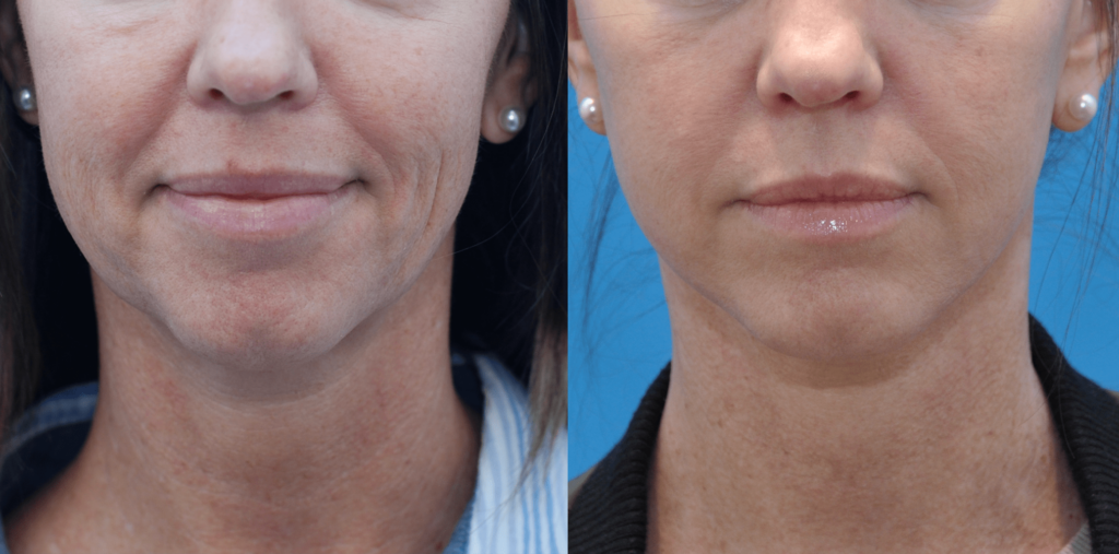 Facelift, necklift, upper bleph, lower blepharoplasty with fat grafting, chemical peel