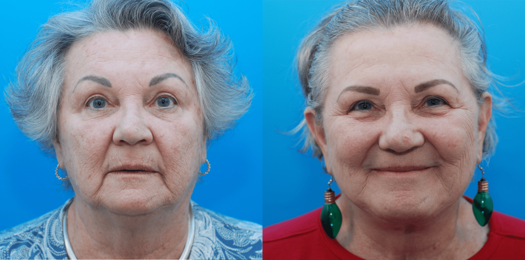 Facelift, necklift, lip lift, CO2 laser