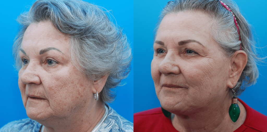 Facelift, necklift, lip lift, CO2 laser