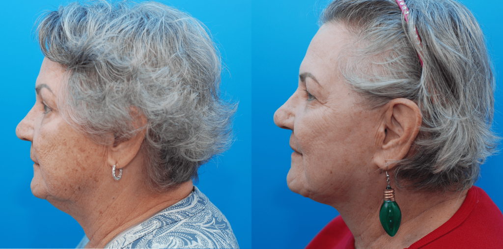 Facelift, necklift, lip lift, CO2 laser