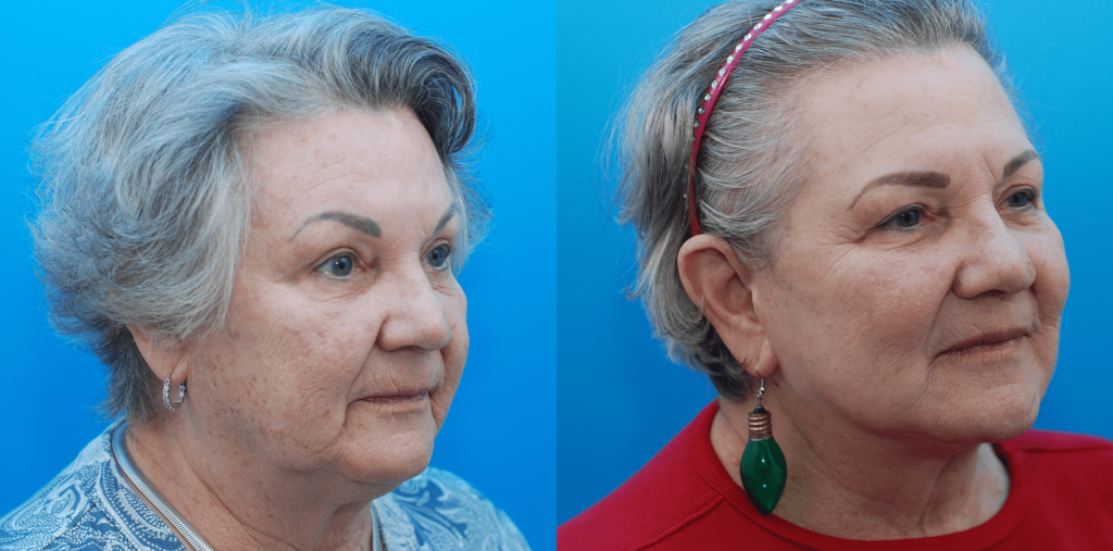 Facelift, necklift, lip lift, CO2 laser