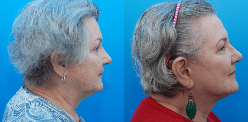 Facelift, necklift, lip lift, CO2 laser