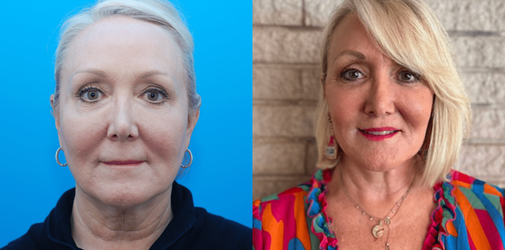 Browlift, upper & lower blepharoplasty, facial fat grafting, facelift, necklift, lip lift, CO2 laser