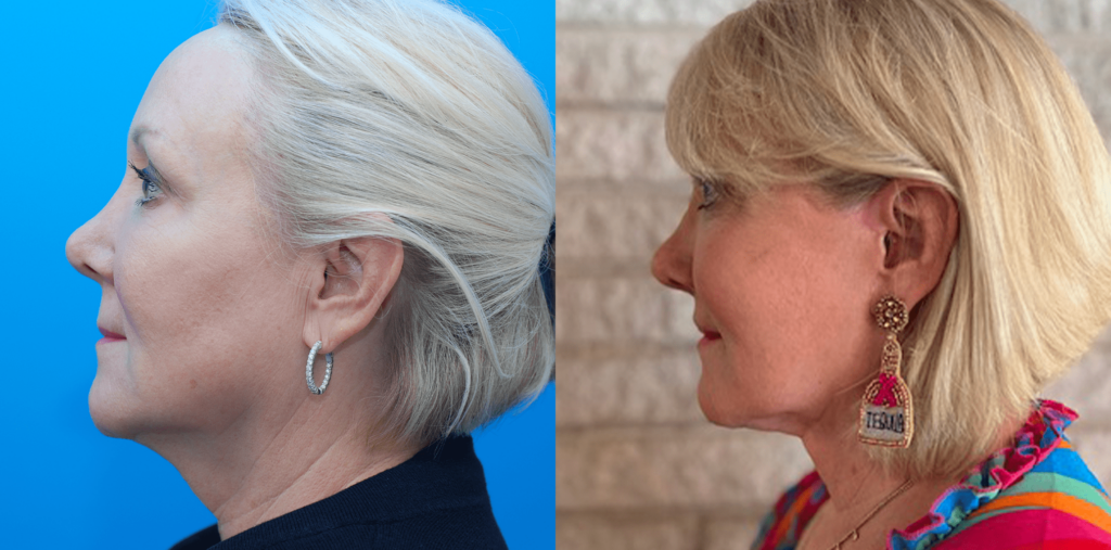 Browlift, upper & lower blepharoplasty, facial fat grafting, facelift, necklift, lip lift, CO2 laser