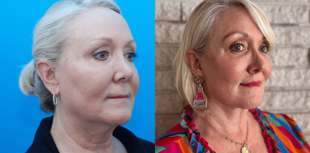 Browlift, upper & lower blepharoplasty, facial fat grafting, facelift, necklift, lip lift, CO2 laser