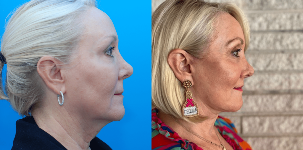 Browlift, upper & lower blepharoplasty, facial fat grafting, facelift, necklift, lip lift, CO2 laser