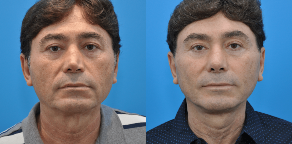 Facelift, necklift, browlift, upper blepharoplasty, revision rhinoplasty