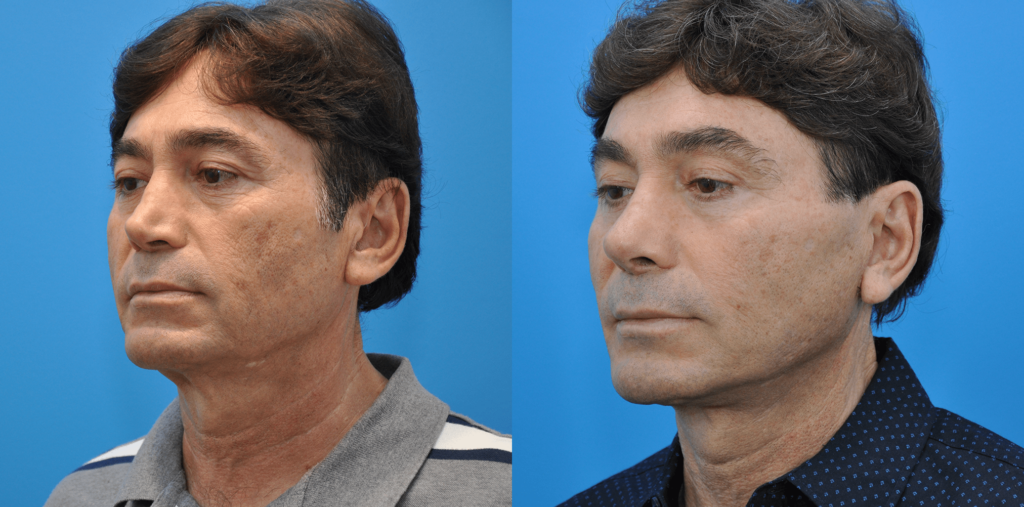 Facelift, necklift, browlift, upper blepharoplasty, revision rhinoplasty