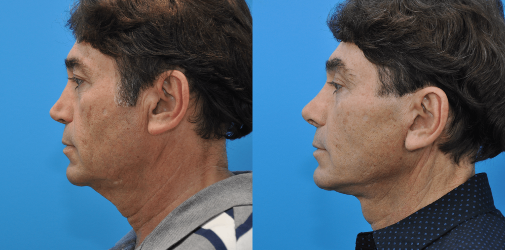 Facelift, necklift, browlift, upper blepharoplasty, revision rhinoplasty