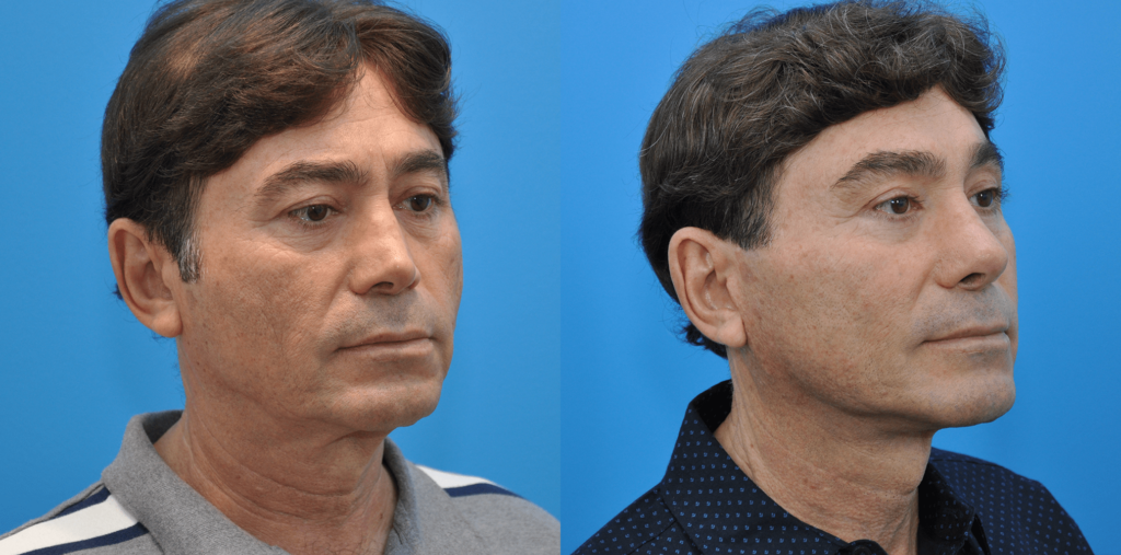 Facelift, necklift, browlift, upper blepharoplasty, revision rhinoplasty