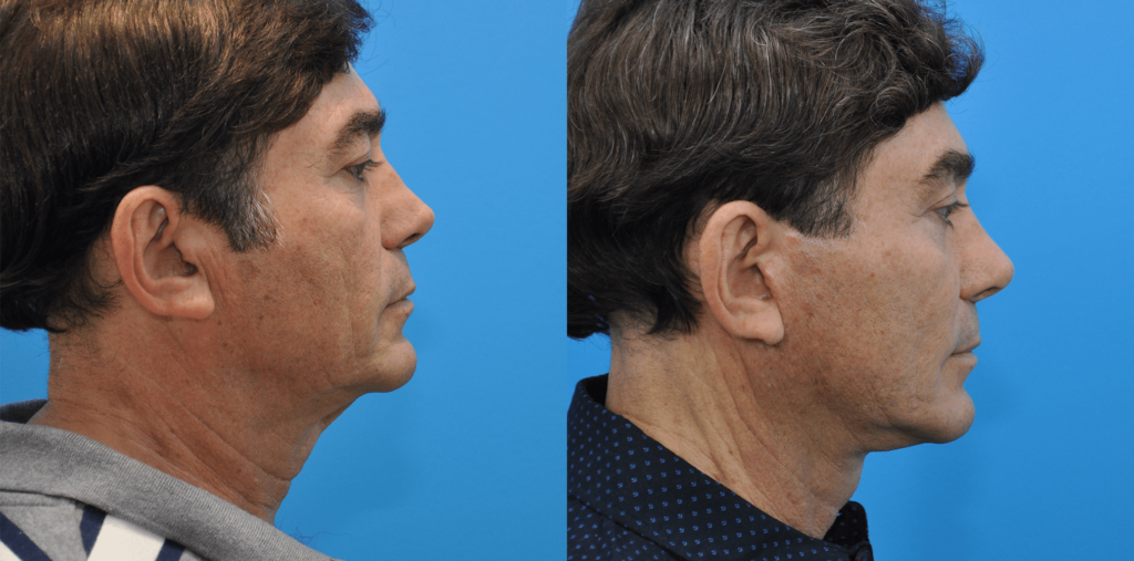 Facelift, necklift, browlift, upper blepharoplasty, revision rhinoplasty