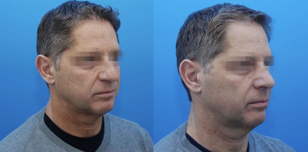 Rhinoplasty