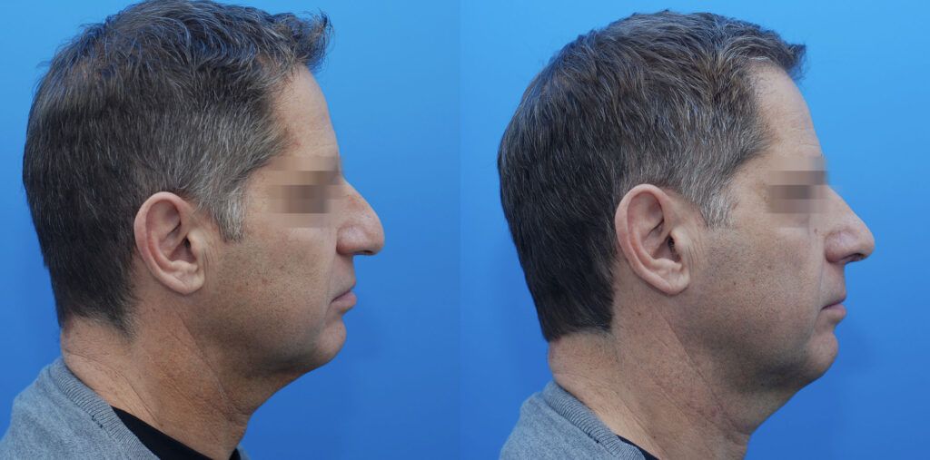 Rhinoplasty