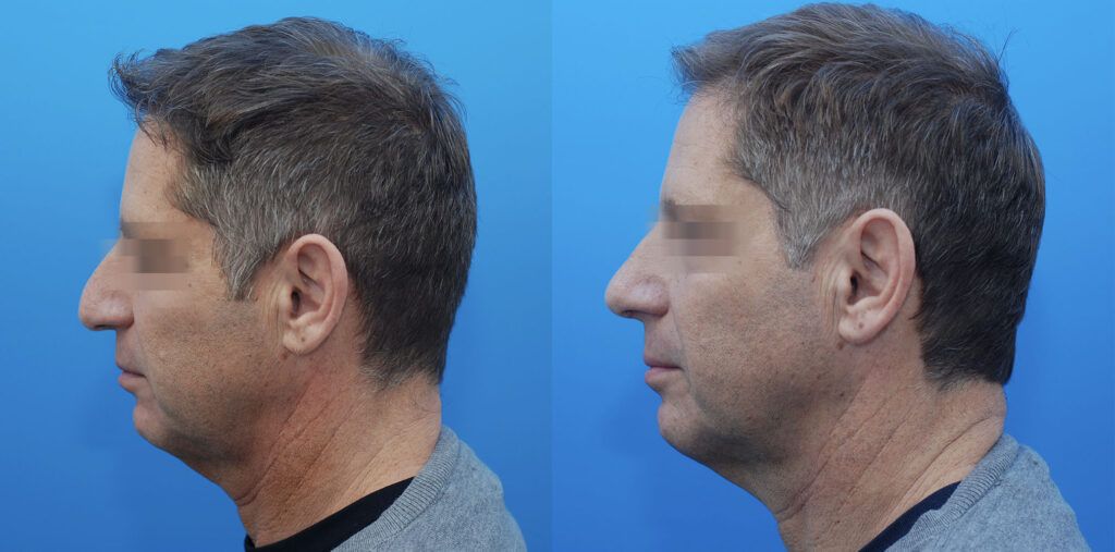 Rhinoplasty