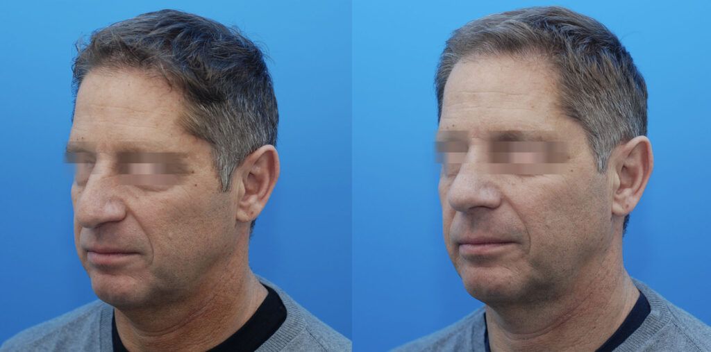Rhinoplasty