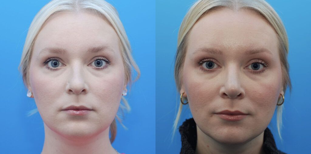 Rhinoplasty