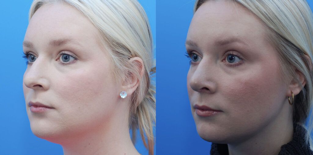 Rhinoplasty
