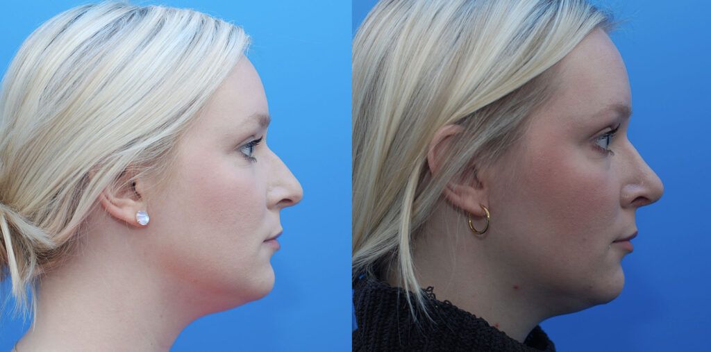 Rhinoplasty