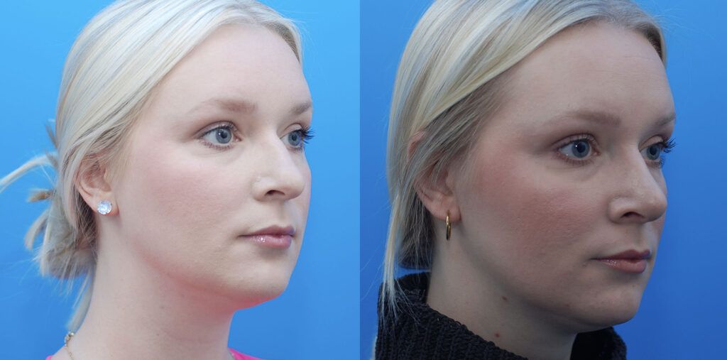 Rhinoplasty