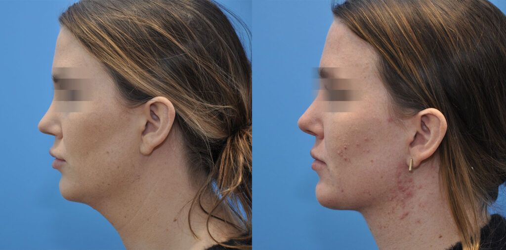 Revision Rhinoplasty