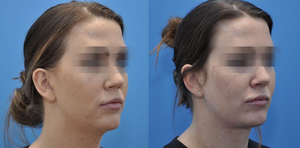 Revision Rhinoplasty