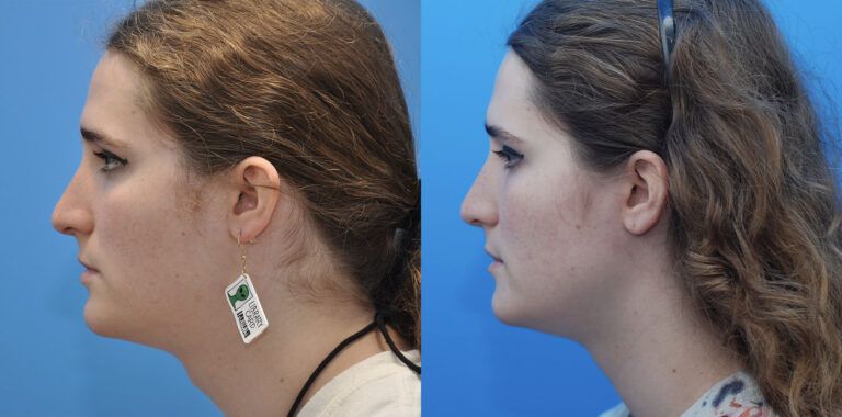 FFS, Chondrolaryngoplasty (Adam's Apple Reduction)