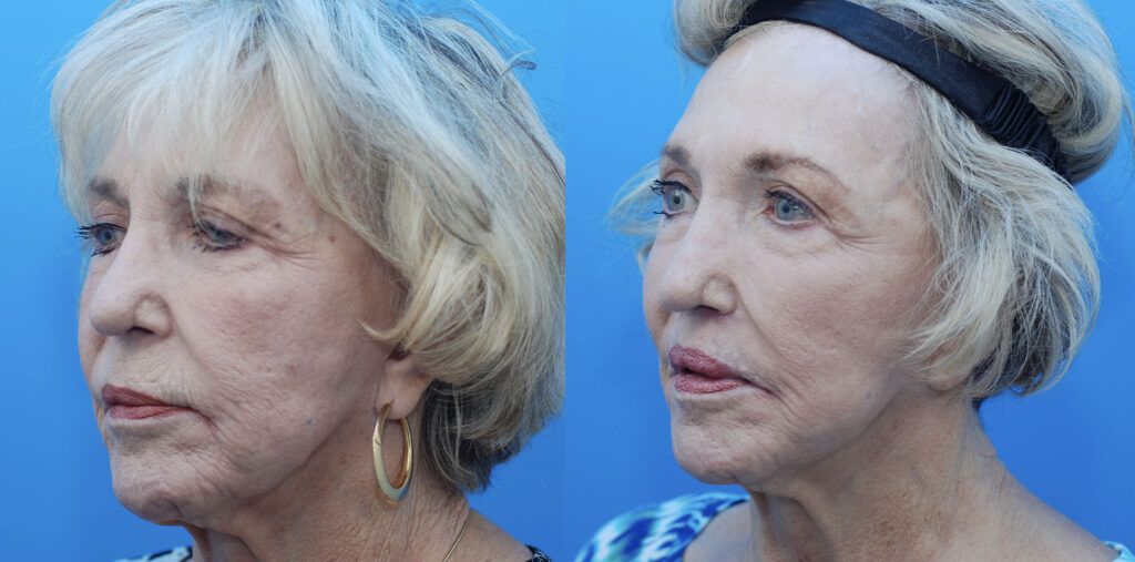 Facial Fat Grafting, lip lift, CO2 laser