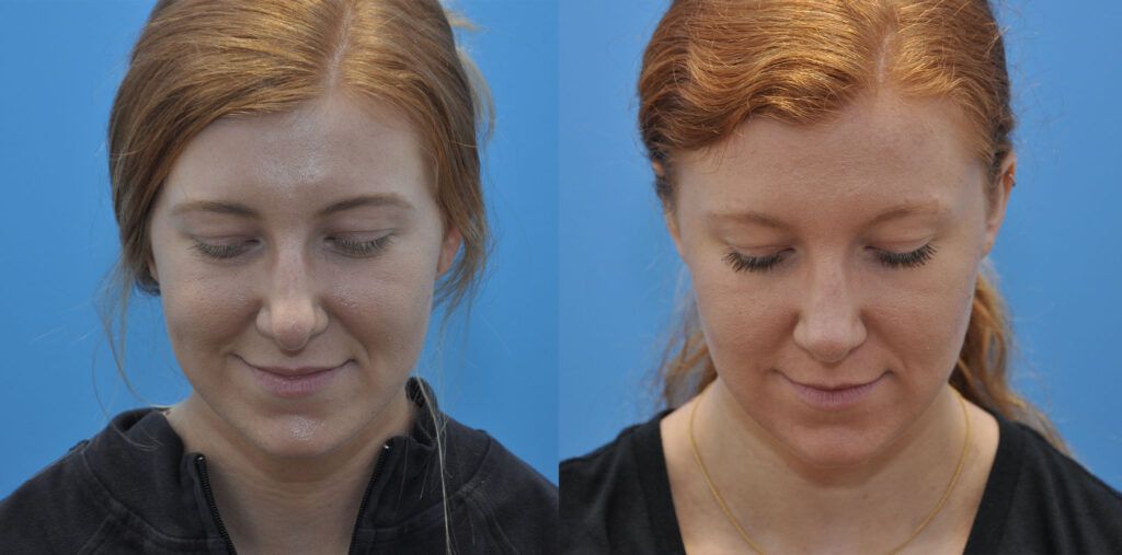 Rhinoplasty