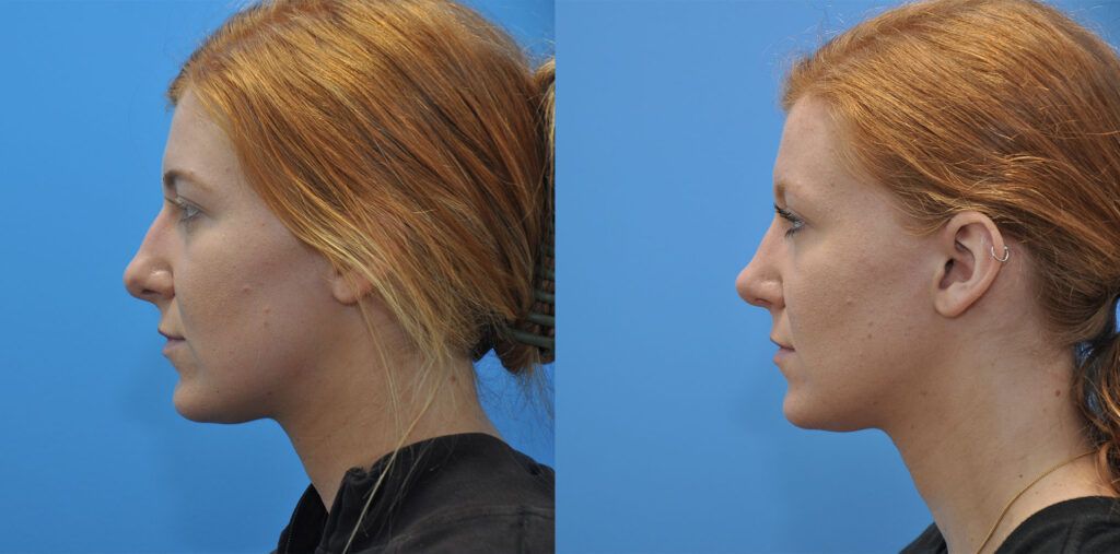 Rhinoplasty