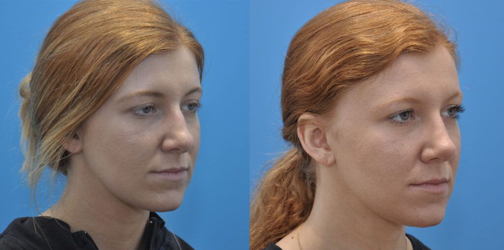 Rhinoplasty