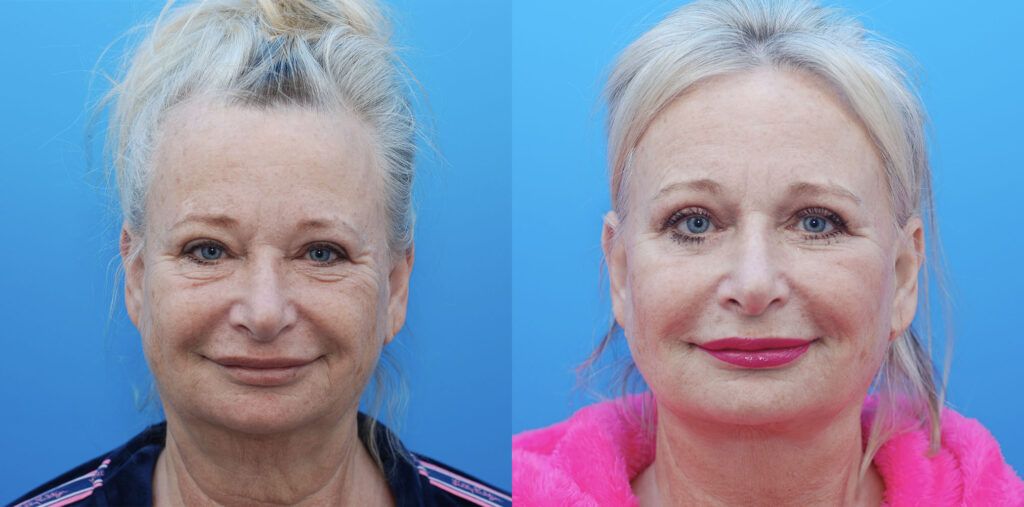 Facelift, necklift, upper bleph, lower bleph