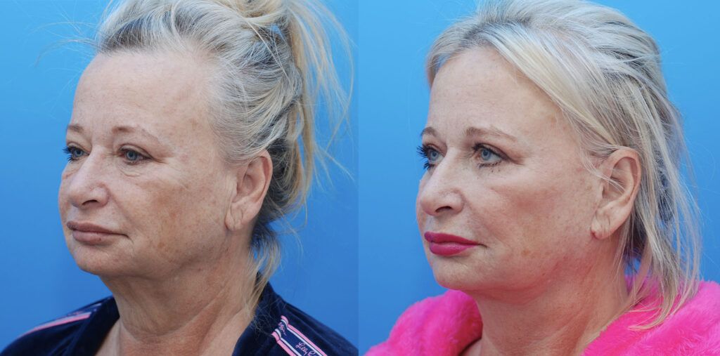 Facelift, necklift, upper bleph, lower bleph
