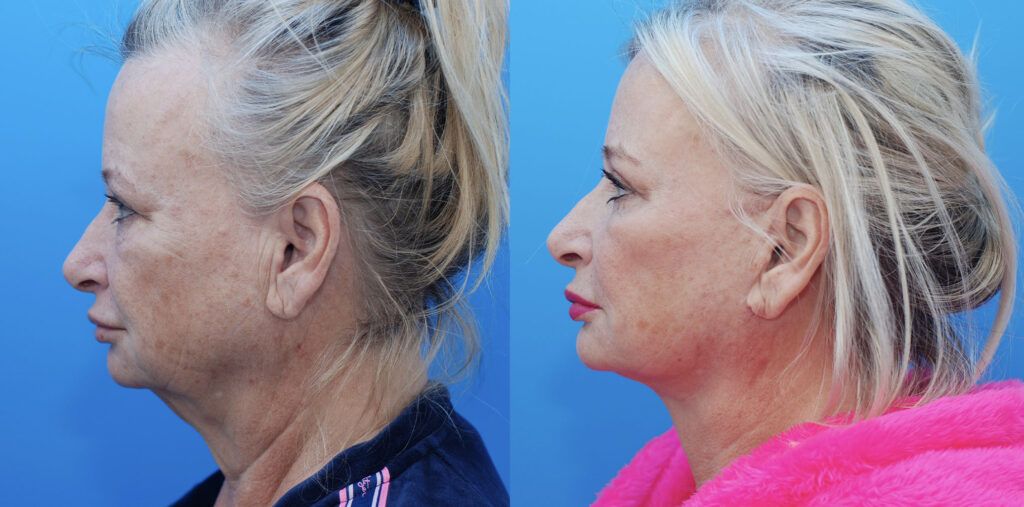 Facelift, necklift, upper bleph, lower bleph