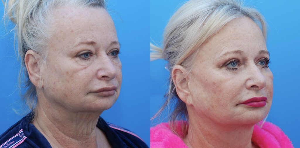 Facelift, necklift, upper bleph, lower bleph