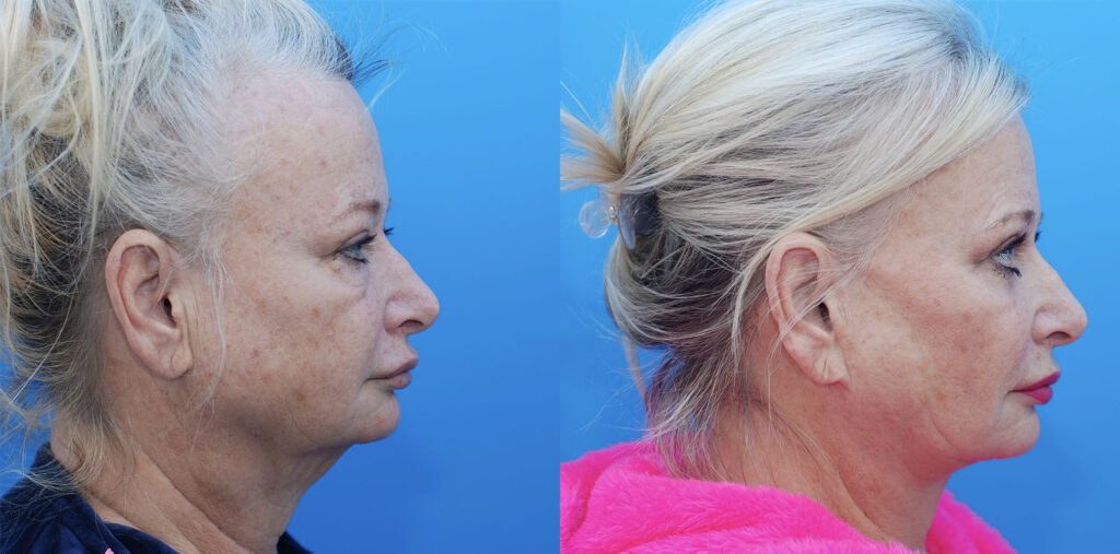 Facelift, necklift, upper bleph, lower bleph