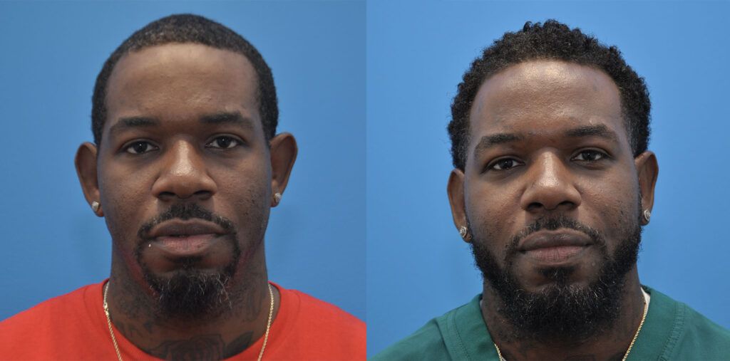 Otoplasty, rhinoplasty