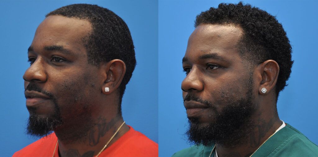 Otoplasty, rhinoplasty