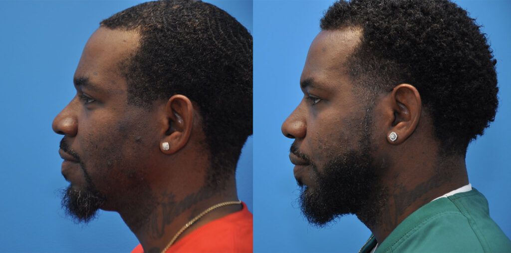 Otoplasty, rhinoplasty