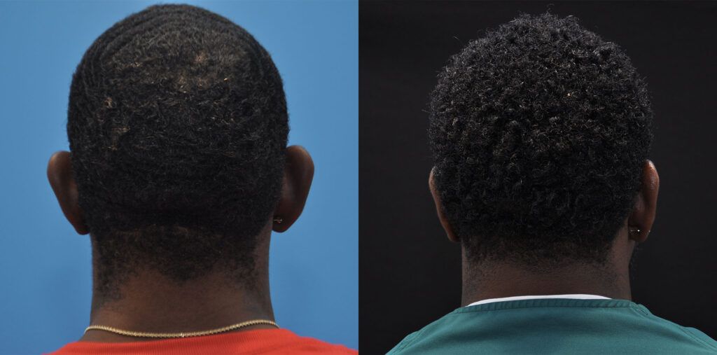 Otoplasty, rhinoplasty